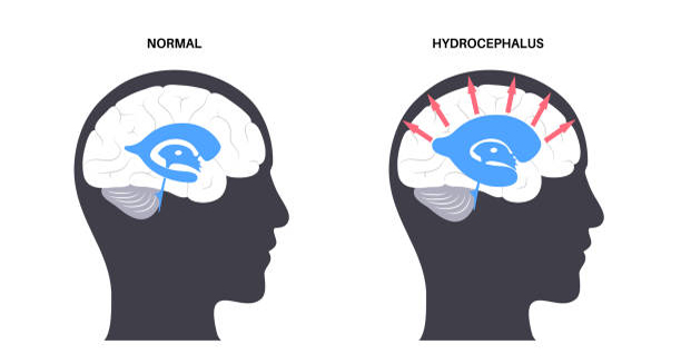 Chiari malformation complications with hydrocephalus illustration