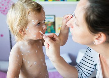 Mother applying lotion to child with chickenpox rash