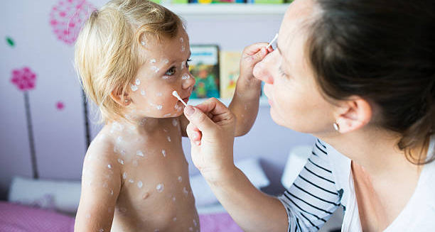 Mother applying lotion to child with chickenpox rash
