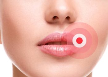 Close-up of a woman’s lips with highlighted cold sore area