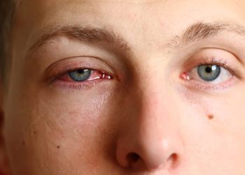 Close-up of a man with conjunctivitis in one eye