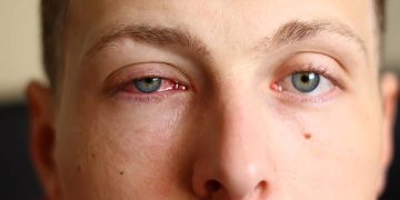 Close-up of a man with conjunctivitis in one eye