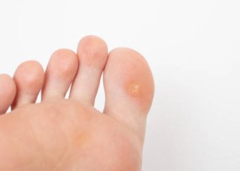 Close-up image of a foot showing a corn on a toe, highlighting potential complications and recovery.