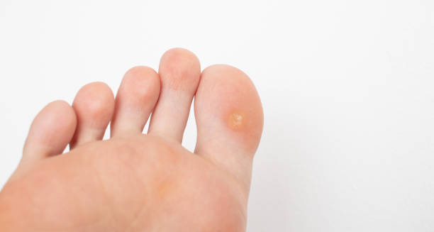 Close-up image of a foot showing a corn on a toe, highlighting potential complications and recovery.