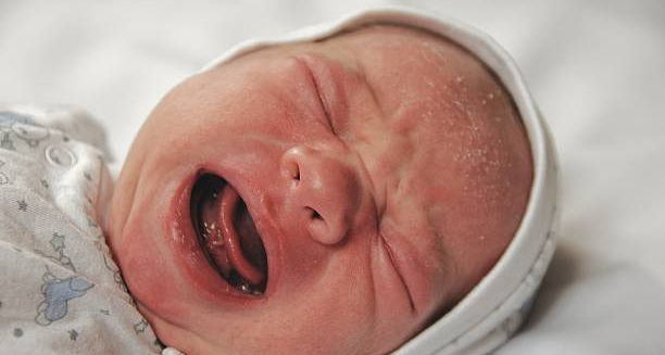 Crying newborn with visible flaky skin on the scalp and forehead, showing signs of cradle cap.