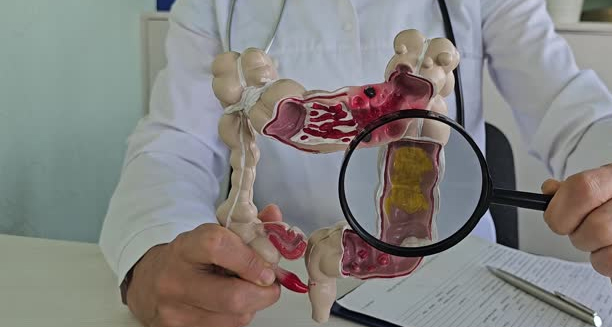 Complications and Recovery from Crohn’s Disease