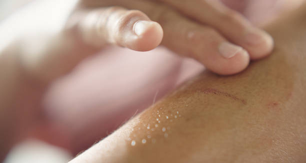 Person applying ointment to a healing cut on the arm.