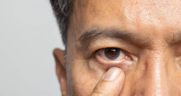 Close-up of eye after retinal surgery