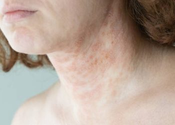Discoid eczema on the neck showing severe skin inflammation and discolouration