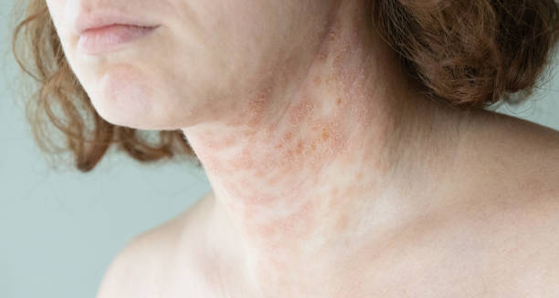 Discoid eczema on the neck showing severe skin inflammation and discolouration