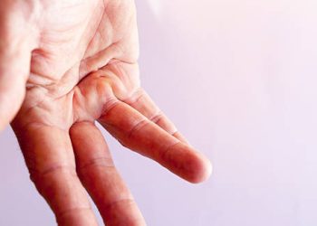 Hand showing finger deformity due to Dupuytren’s Contracture complications