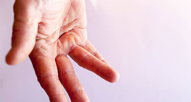 Hand showing finger deformity due to Dupuytren’s Contracture complications