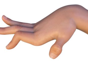Twisted hand showing muscle contraction due to dystonia