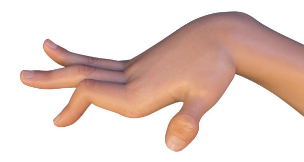 Twisted hand showing muscle contraction due to dystonia