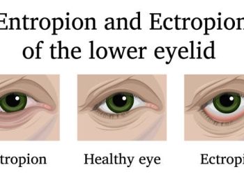 Medical illustration showing a healthy eye compared to eyes with entropion and ectropion of the lower eyelid.