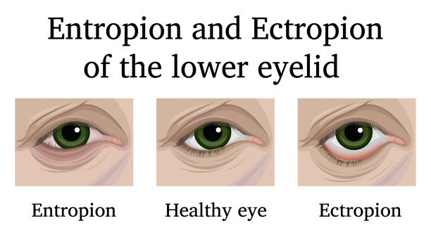 Medical illustration showing a healthy eye compared to eyes with entropion and ectropion of the lower eyelid.