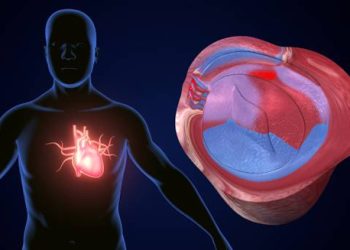 Illustration of heart valve damage showing complications from endocarditis.