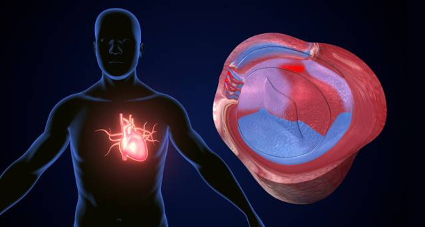 Illustration of heart valve damage showing complications from endocarditis.
