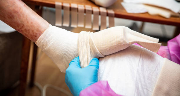Medical professional wrapping a severely affected foot due to Epidermolysis Bullosa complications