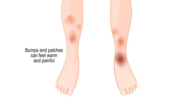 Illustration showing inflamed and painful patches on legs due to erythema nodosum