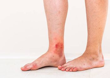 Lower leg with inflamed and broken skin showing complications of erythromelalgia