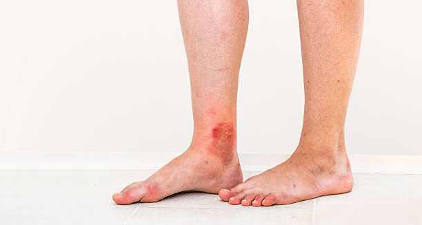 Lower leg with inflamed and broken skin showing complications of erythromelalgia