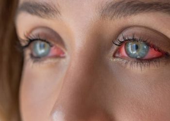 Close-up of irritated eyes with redness due to conjunctivitis