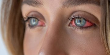Close-up of irritated eyes with redness due to conjunctivitis