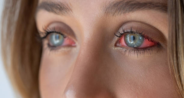 Close-up of irritated eyes with redness due to conjunctivitis