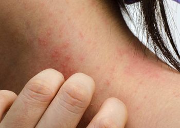 Close-up of a woman's hand scratching inflamed, itchy skin on her neck due to contact dermatitis.