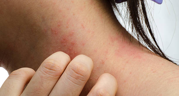 Close-up of a woman's hand scratching inflamed, itchy skin on her neck due to contact dermatitis.