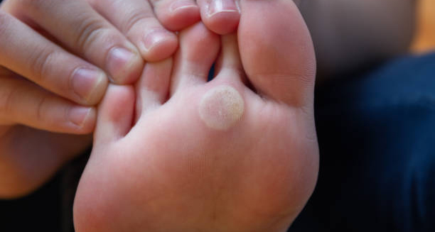 Close-up of a foot with a visible corn on the sole, showing thickened, hardened skin.