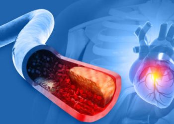 Medical illustration showing plaque buildup in an artery leading to the heart, representing coronary heart disease.