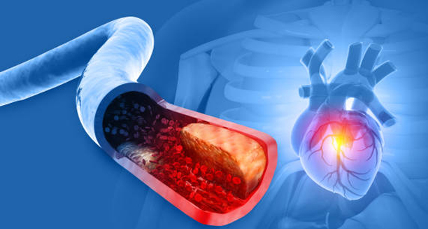 Medical illustration showing plaque buildup in an artery leading to the heart, representing coronary heart disease.