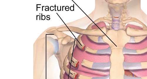 Medical illustration of a human torso showing multiple fractured ribs labeled clearly on the left side.