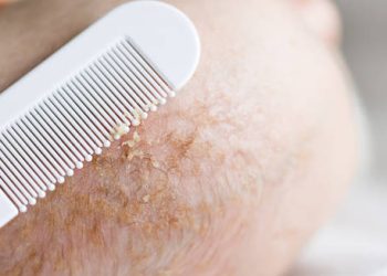 Close-up of a baby’s scalp with visible cradle cap flakes being gently removed using a fine-tooth comb.
