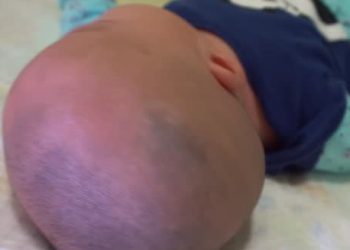 Close-up of an infant’s head from behind, showing abnormal skull shape suggestive of craniosynostosis.