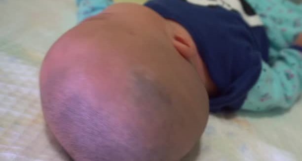 Close-up of an infant’s head from behind, showing abnormal skull shape suggestive of craniosynostosis.