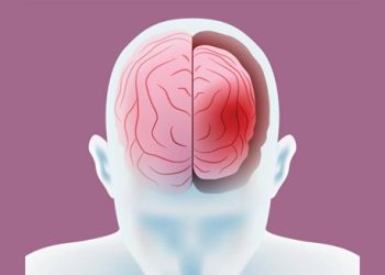 Creutzfeldt-Jakob Disease