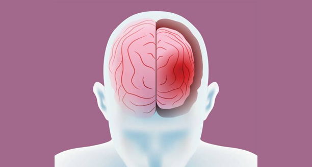 Creutzfeldt-Jakob Disease