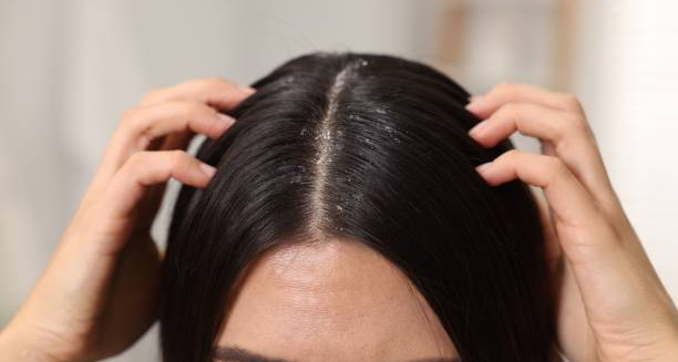 Close-up of a person parting their dark hair to reveal visible dandruff on the scalp