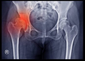 X-ray showing developmental dysplasia of the hip