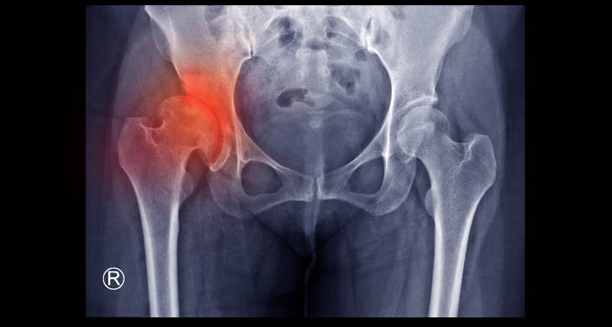 X-ray showing developmental dysplasia of the hip
