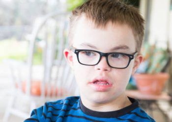 Child with DiGeorge syndrome wearing glasses and showing facial characteristics