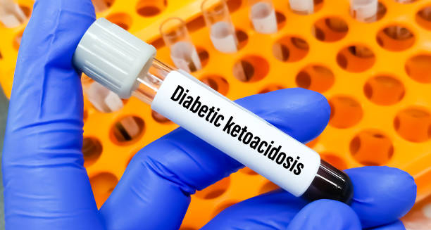 Blood sample labelled diabetic ketoacidosis held by gloved hand
