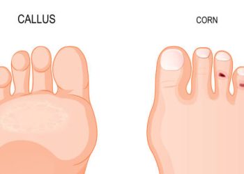 Medical illustration comparing callus and corn on the feet