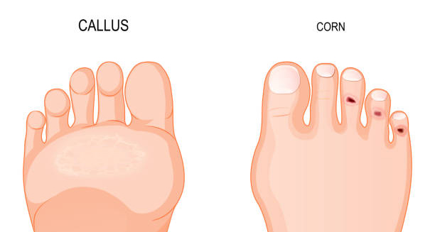 Medical illustration comparing callus and corn on the feet