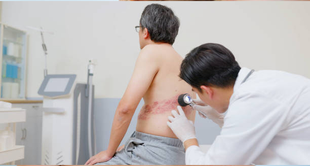 Doctor examining red rash on a male patient's back for chickenpox diagnosis
