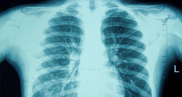 Chest X-ray showing lung damage associated with chronic obstructive pulmonary disease.