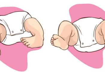 Medical illustration comparing baby with club foot and normal foot position